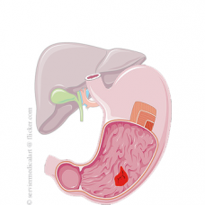 Afectiunile gastrice si ulceroase Afectiunile gastrice si ulceroase