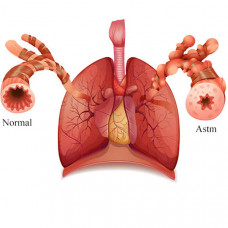 Bolile Aparatului Respirator