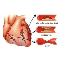 Ateroscleroza coronariana