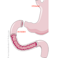 Duodenitele Duodenitele