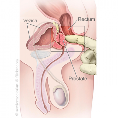 Adenom de prostata: cauze, simptome, complicatii, tratament | Bioclinica