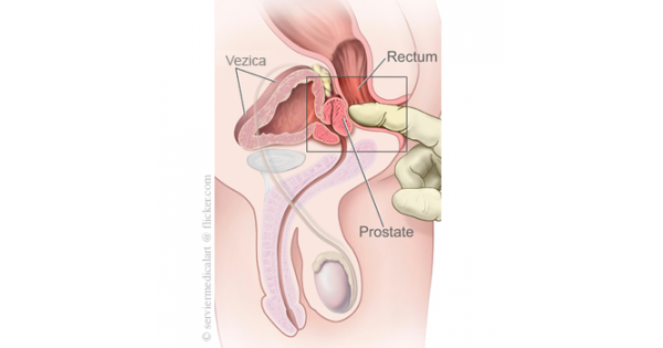 prostatita de adeziune vasculară gimnastică eficientă pentru prostatită